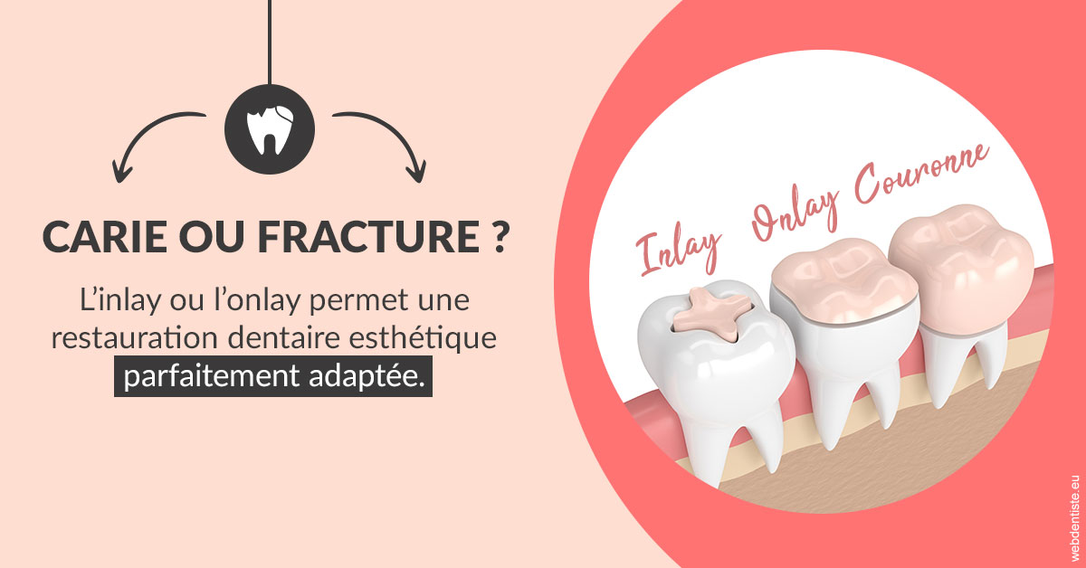 https://www.lecabinetdessourires.fr/T2 2023 - Carie ou fracture 2