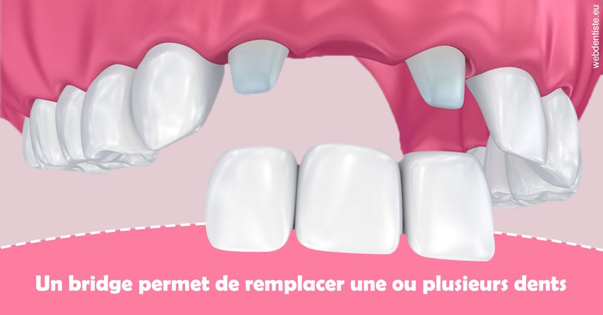 https://www.lecabinetdessourires.fr/Bridge remplacer dents 2