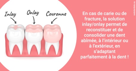 https://www.lecabinetdessourires.fr/L'INLAY ou l'ONLAY 2