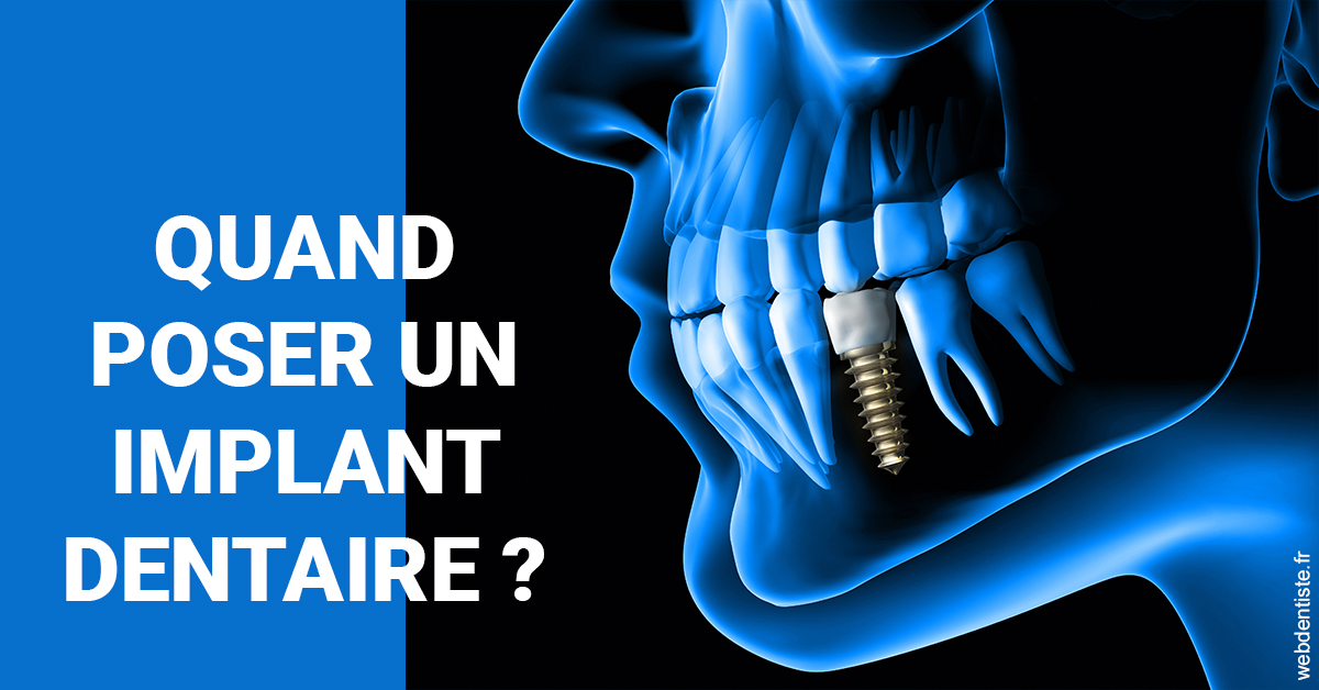 https://www.lecabinetdessourires.fr/Les implants 1
