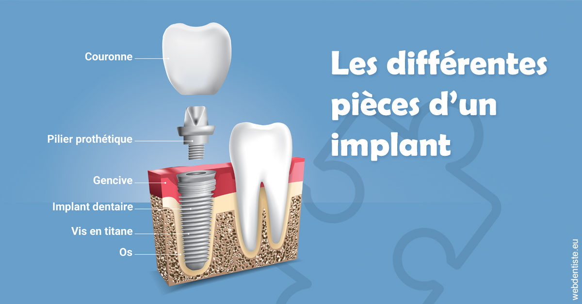 https://www.lecabinetdessourires.fr/Les différentes pièces d’un implant 1